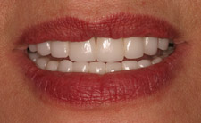 Corrected top teeth after treatment