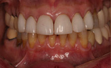 Yellow bottom teeth before treatment