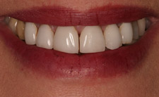 Gapped top teeth before treatment