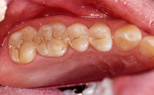 Two teethwith tooth colored fillings