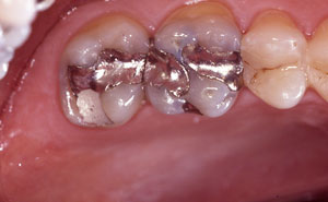 Two teeth with silver fillings