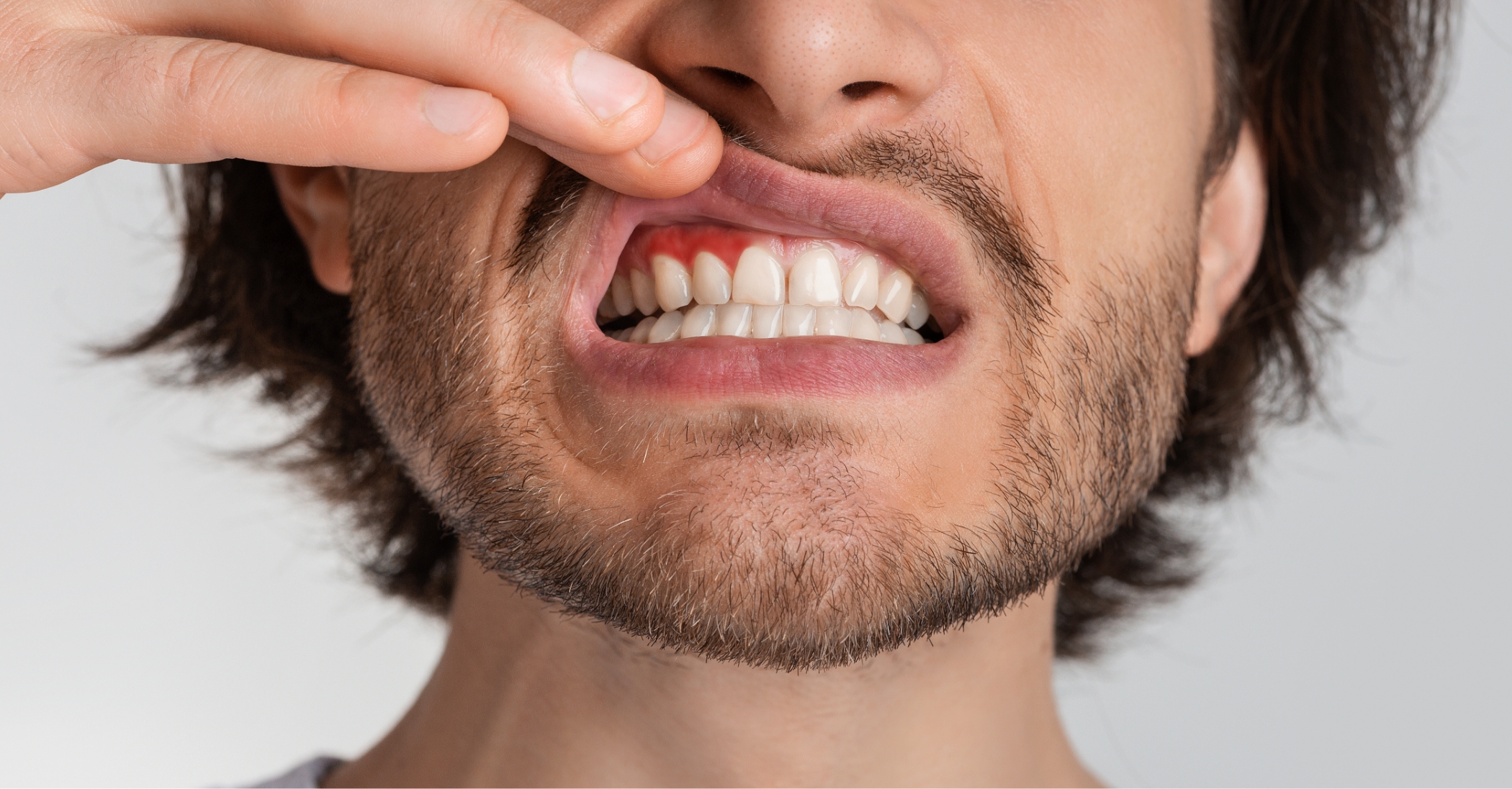 Man pointing to his red gums before gum disease treatment in Massapequa Park