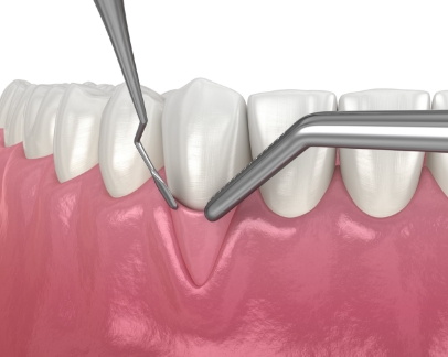 Illustration of gum tissue being added to an area of the gums with recession