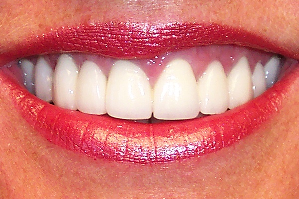 Closeup of smile with even gum line
