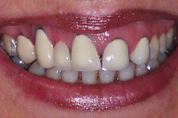 Closeup of smile with uneven gum line