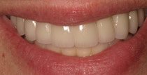 Closeup of smile with natural looking implant denture