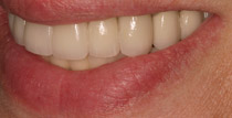Closeup of right side of smile with implant denture