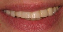 Closeup of traditional denture front