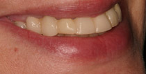 Closeup of left side of smile with removable denture