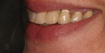 Closeup of traditional denture right side