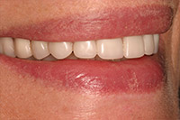 Side of smile with implant denture in place