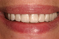 Front of smile with implant denture in place