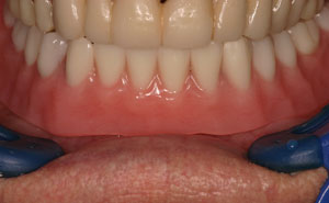 Dental restoration attached to two dental implants