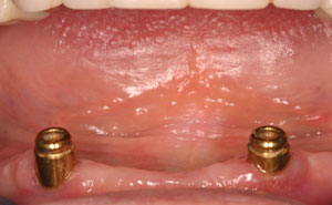 Two dental implants in the gums