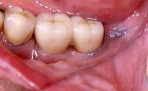 Closeup of replacement teeth attached to implants