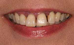 dentures bellmore