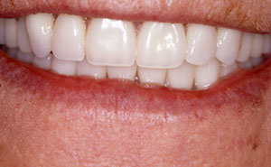 dentures massapequa