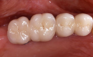 Replacement teeth attached to implants