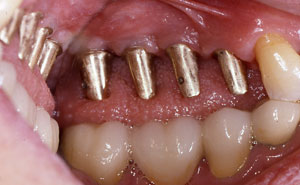 Four dental implants in place