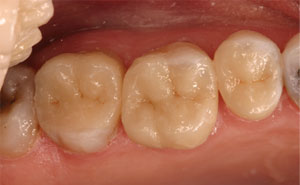 Metal fillings replaced with porcelain onlays