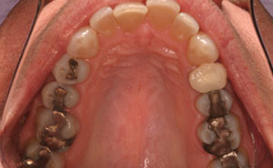 Back teeth with metal fillings