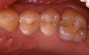 Metal fillings replaced with porcelain inlays