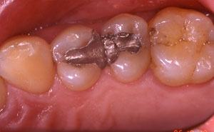 Two teeth with metal fillings