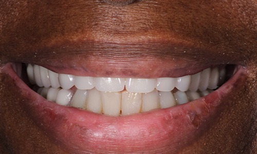 dentures seaford
