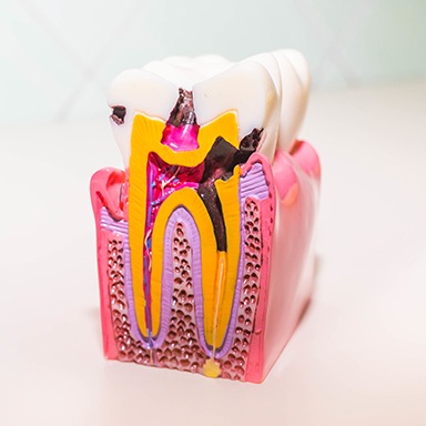 Model tooth displaying the effects of a root canal