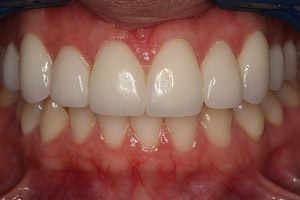 Closeup woman's teeth and gums after porcelain veneers