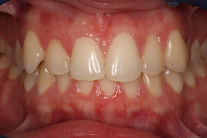 Closeup woman's teeth and gums before porcelain veneers