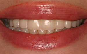Closeup of beauitufl teeth after smile makeover