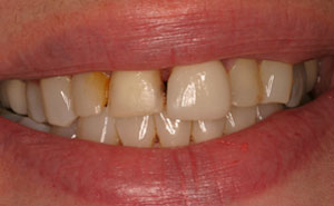 Closeup of damaged discolored smile before makeover
