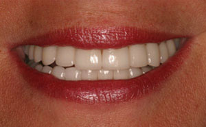 White teeth after makeover