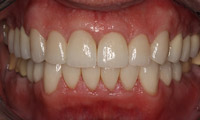 Older man after crown teeth and gums closeup
