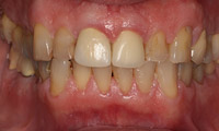 Closeup man's teeth and gums before full mouth reconstruction