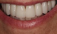 Closeup of front of smile of full makeover patient after