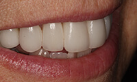 Closeup of side of smile of full makeover patient after