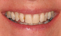 Before image of cracked, spaced and brown teeth