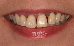 Dicolored and decayed teeth before makeover