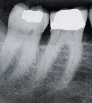 X-ray of teeth with fillings