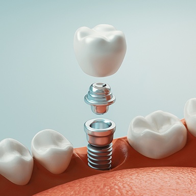 Close-up digital illustration of a dental implant 