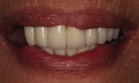 Closeup of bad dentures