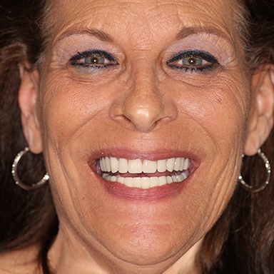 A geriatric dental patient smiling with high-quality cosmetic dentures