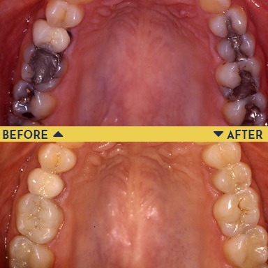 Before image of teeth with metal/amalgam fillings with an after image of teeth below it with new tooth-colored fillings