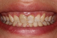 September 2020 gummy smile correction dental patient before treatment closeup