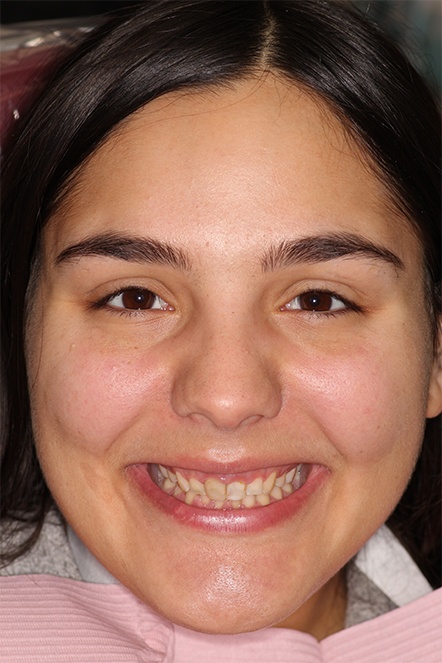 September 2020 gummy smile correction dental patient before treatment