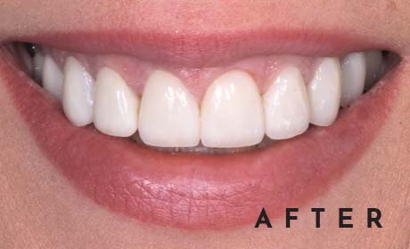 closeup of Kim's beautiful teeth after her cosmetic work