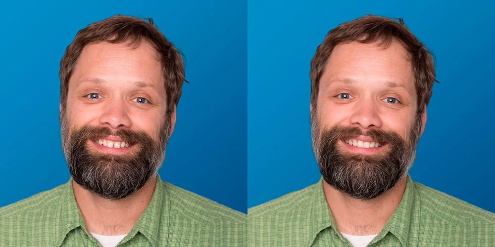 SmileView before and after 2