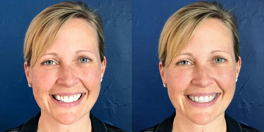 SmileView before and after 4